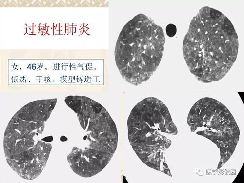 关于二期梅毒的症状是怎么样的 关于二期梅毒的症状是怎么样的