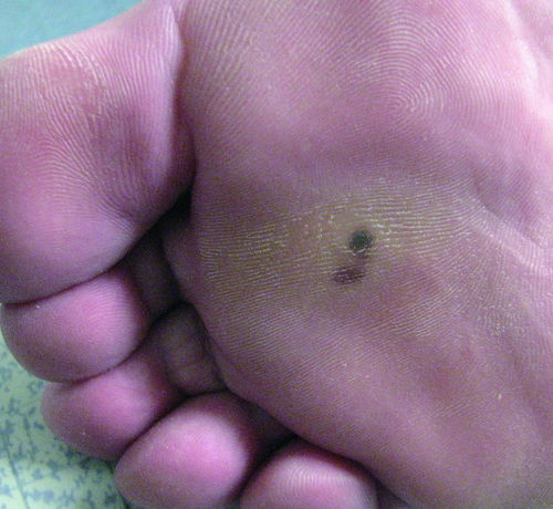 白血病人大姨妈会血流不止吗 白血病人大姨妈会血流不止吗