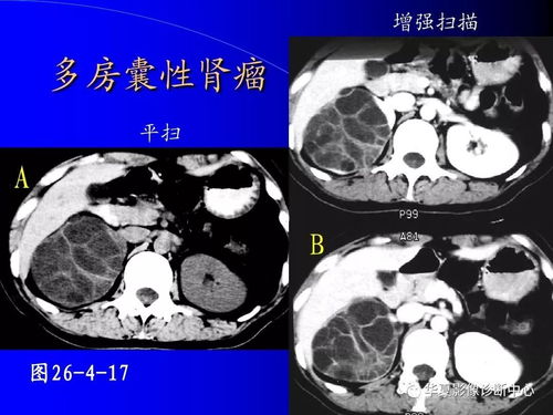 预防梅毒有哪些方式呢 预防梅毒有哪些方式呢