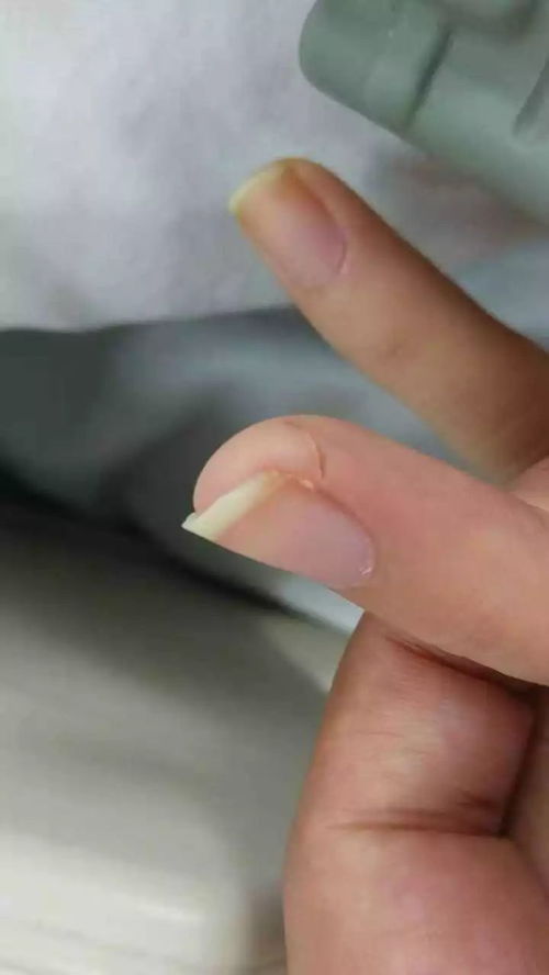 一期梅毒的临床症状都有什么 一期梅毒的临床症状都有什么