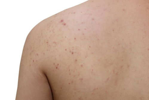 ÷ŮԳ֢״ Ů÷Ҫ֢״ʲô