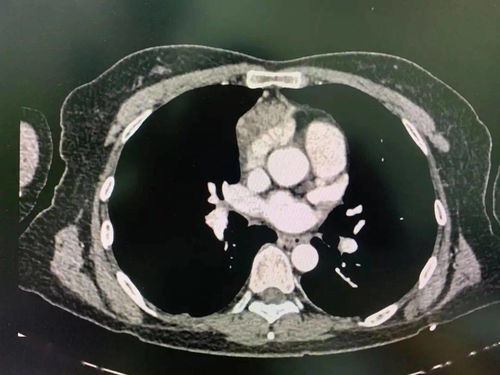 cva医学上是什么意思 cva医学上是什么意思