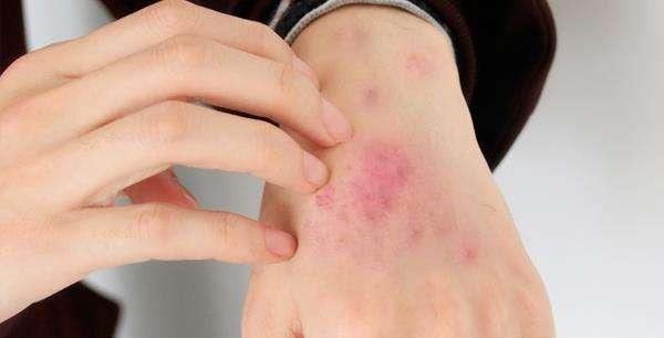 淋病怎么分慢性和急性 淋病怎么分慢性和急性