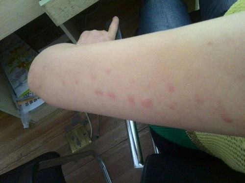 梅毒的治愈标准有哪些 梅毒的治愈标准有哪些