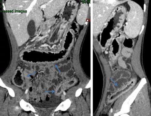 艾滋病与哪些疾病容易混淆 艾滋病与哪些疾病容易混淆