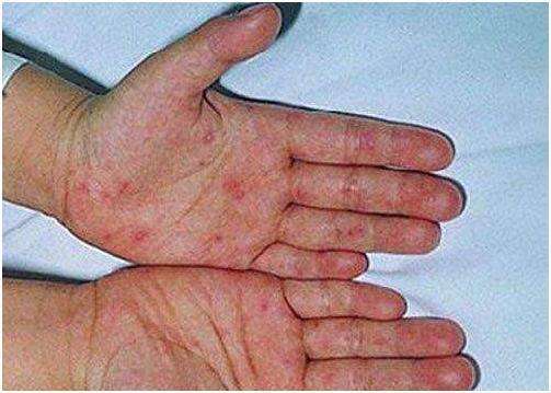 肺癌晚期身体冰凉又出汗是怎么回事 肺癌晚期身体冰凉又出汗是怎么回事