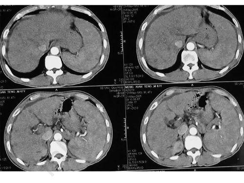 哪些原因造成梅毒复发 哪些原因造成梅毒复发