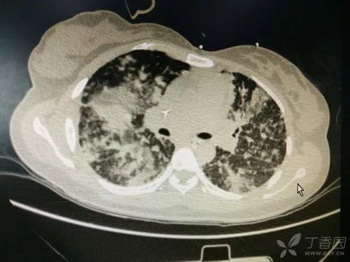 牙龈经常无故出血是什么原因 牙龈经常无故出血是什么原因