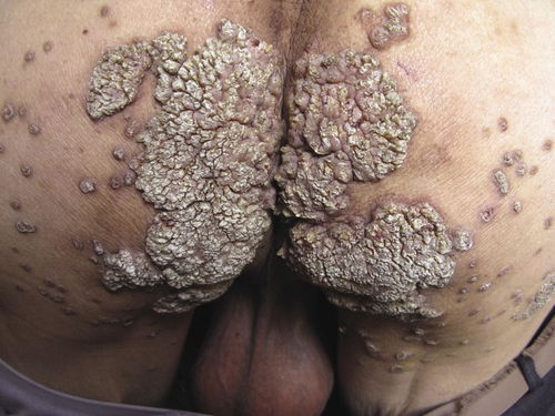 怎么正确诊断梅毒方法 怎么正确诊断梅毒方法