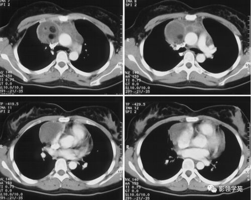 为什么我的脂肪瘤又青又疼 为什么我的脂肪瘤又青又疼