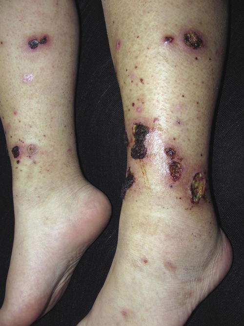 警惕皮肤接触也能传染梅毒 警惕皮肤接触也能传染梅毒