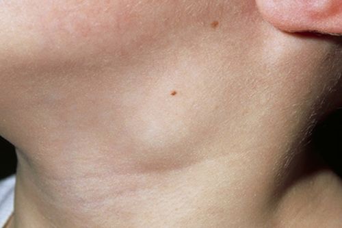 什么叫做先天梅毒 什么叫做先天梅毒