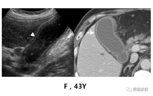 孕妇做梅毒血清试验的注意事项 孕妇做梅毒血清试验的注意事项