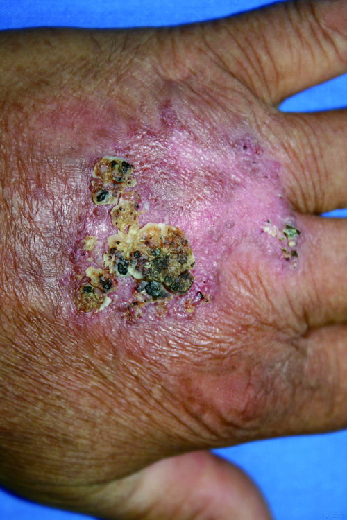 梅毒检测试纸准确吗 梅毒检测试纸准确吗