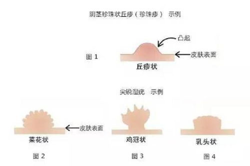 艾滋病怎么预防 艾滋病怎么预防