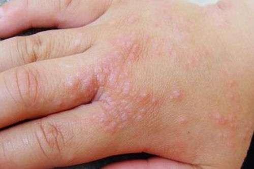 已婚少妇艾滋病 妙龄少女感染艾滋病报复社会 已婚少妇艾滋病 妙龄少女感染艾滋病报复社会