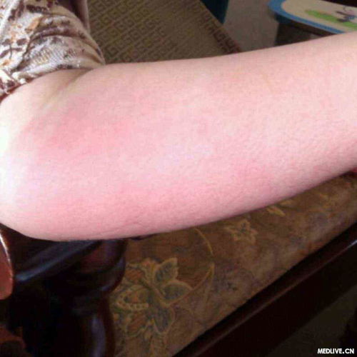 前期艾滋病症状 前期艾滋病症状