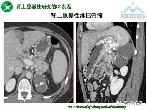 蚊子叮了艾滋病人后叮你会感染吗(为什么蚊子不传染HIV) 蚊子叮了艾滋病人后叮你会感染吗(为什么蚊子不传染HIV)